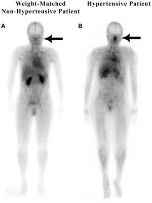 Nasal turbinate lymphatic obstruction: a proposed new paradigm in the etiology of essential hypertension